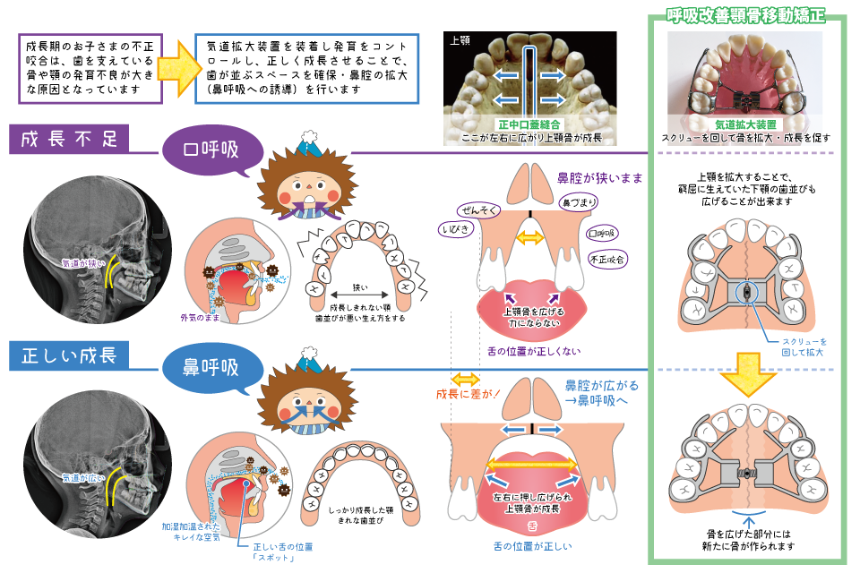 呼吸改善顎骨移動矯正の仕組み