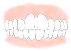 歯と歯の間が空いている【空隙歯列（くうげきしれつ）】