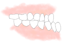 下あごが出ている【下顎突出（かがくぜんとつ）・受け口】