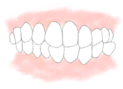 かみ合わせが悪い【交叉咬合（こうさこうごう）】