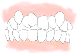 歯並びが悪い【叢生（そうせい）】