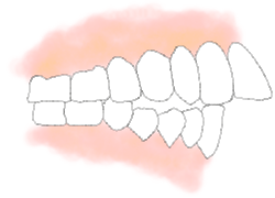 前歯が出ている【上顎前突症（じょうがくぜんとっしゅつ）】