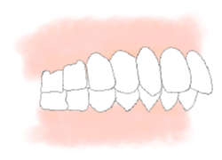 下の歯が前歯がかぶさって見えない【過蓋咬合（かがいこうごう）】